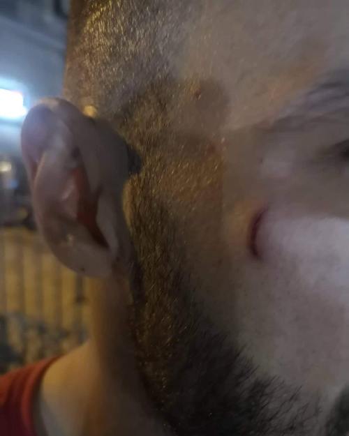 Χαράκωσαν τερματοφύλακα ερασιτεχνικής ομάδας της Ηλιούπολης σε φιλικό αγώνα